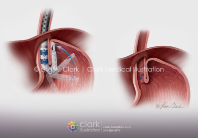 Esophagogastric Fundoplication Illustration