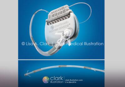 Medtronic Ankerstim Occipital Nerve Stimulation Device Illustration