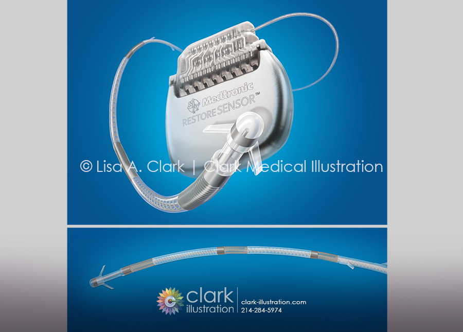 Medtronic Ankerstim Occipital Nerve Stimulation Device Illustration