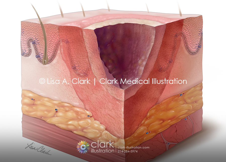 Burn zones illustration