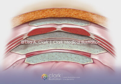 Abdominal Graft Illustration