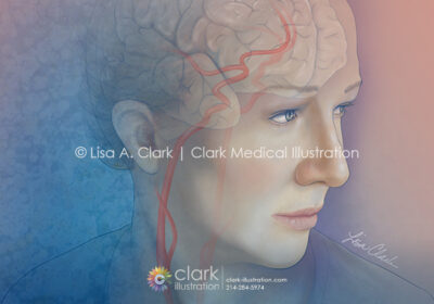 Carotid and Cerebral Artery Illustration
