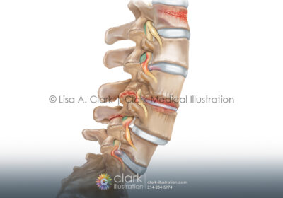 Spinal Conditions Illustration