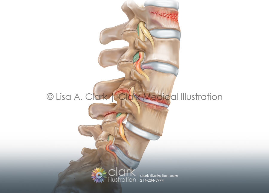 Spinal Conditions Illustration
