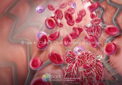 Stent and clot illustration