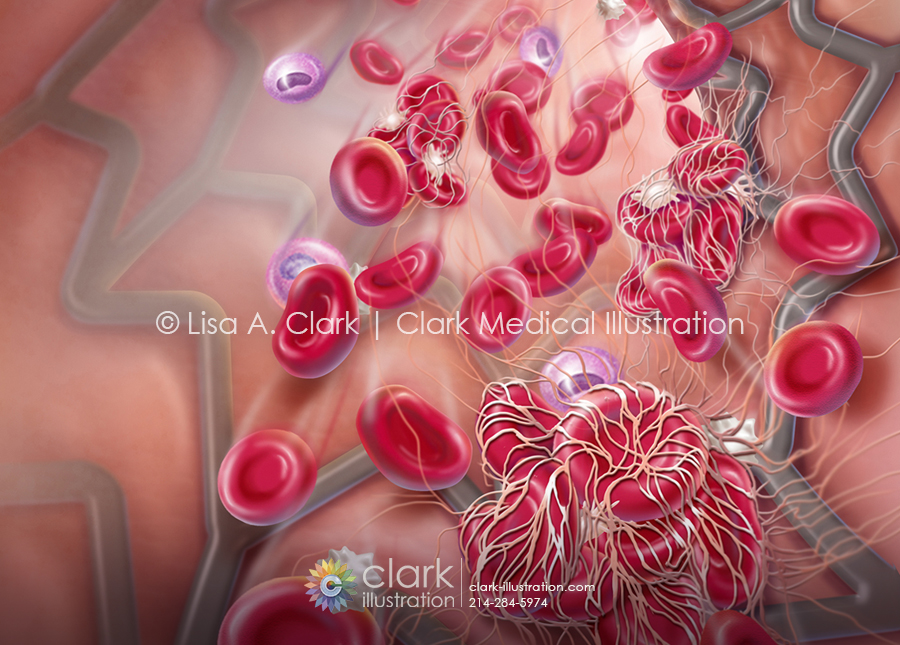 Stent and clot illustration