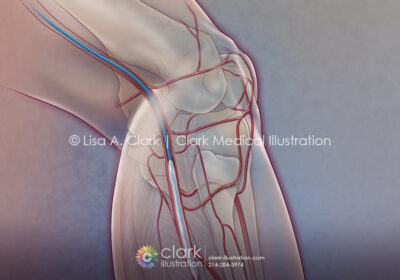 Angioplasty for Peripheral Artery Disease (PAD) Illustration