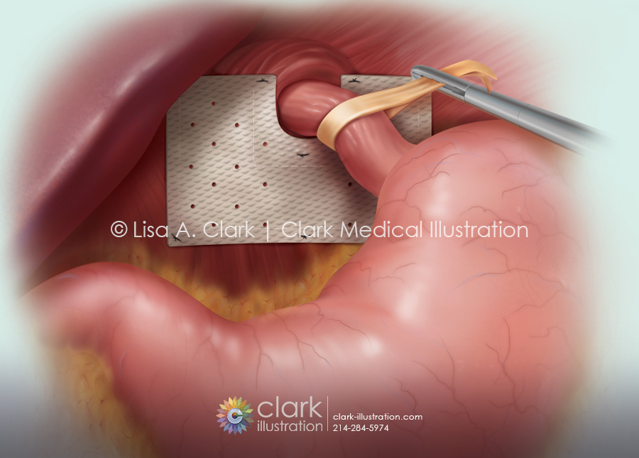 Hiatal Hernia Graft Illustration