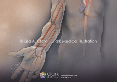 Radial Artery Access for Cardiac Catheterization Illustration