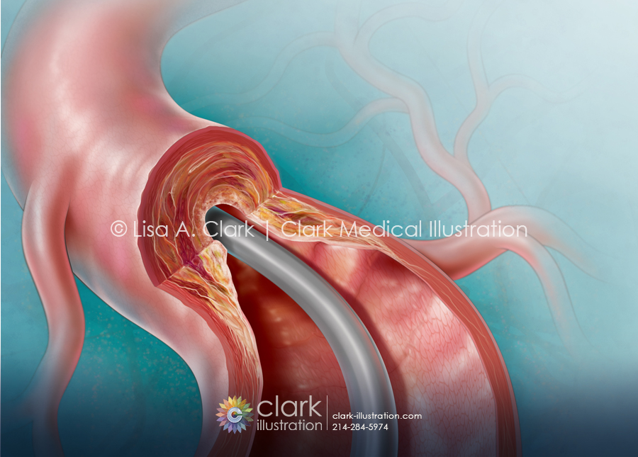 Catheter-Directed Atherectomy Illustration