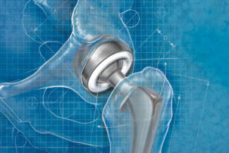 Hip Replacement Blueprint