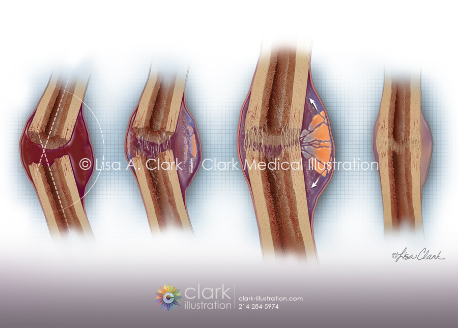 Bone Fracture Healing Illustration